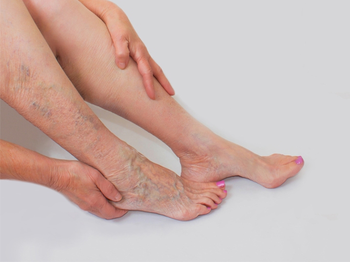 Varicose Veins Risks