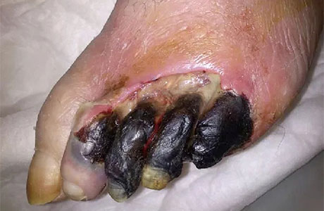 Gangrene