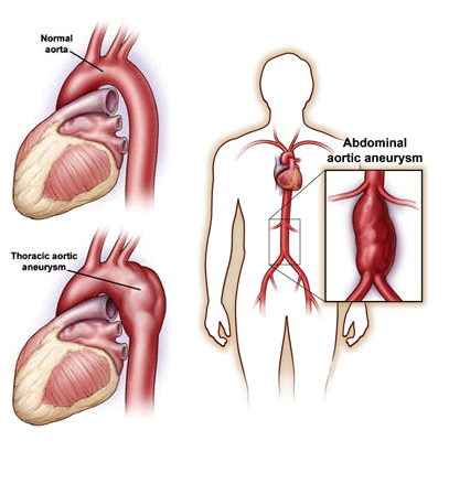 Deep Vein Thrombosis
