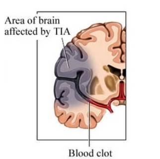 Carotid artery